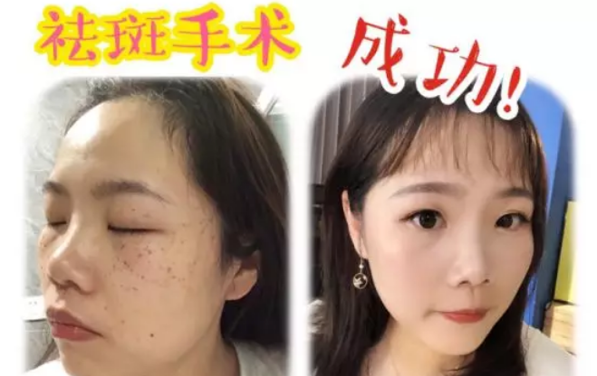 90后全网百万粉丝母婴达人，鹰眼祛斑王全过程分享